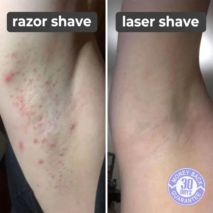 SMARSHAVY® LASER SHAVER حلاقة ليزر سمارشفي